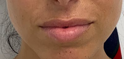 Lip Filler Before & After Gallery - Patient 56158695 - Image 1