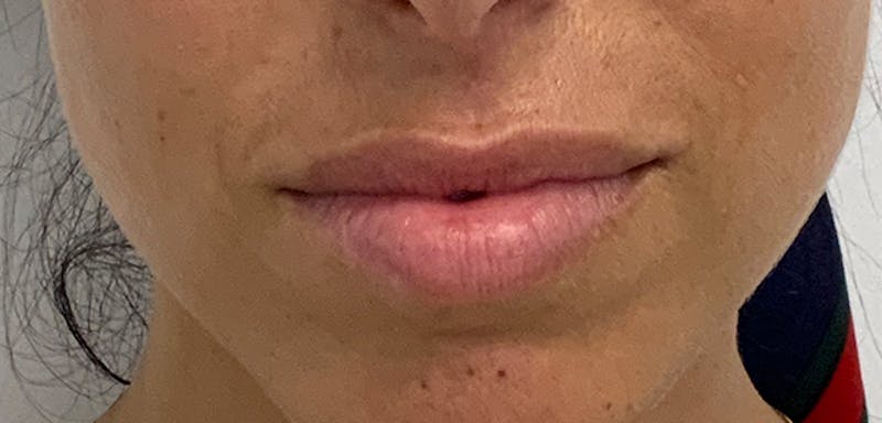 Lip Filler Before & After Gallery - Patient 56158695 - Image 1