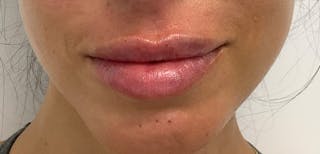 Lip Filler Before & After Gallery - Patient 56158695 - Image 2