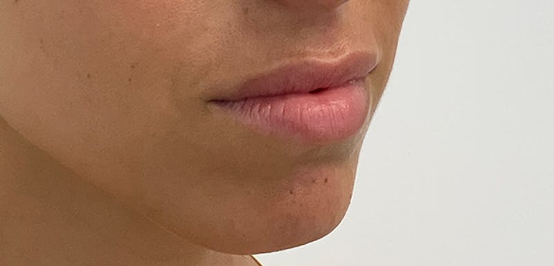 Lip Filler Before & After Gallery - Patient 56158695 - Image 3
