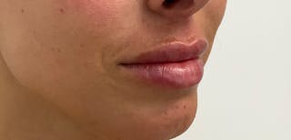 Lip Filler Before & After Gallery - Patient 56158695 - Image 4