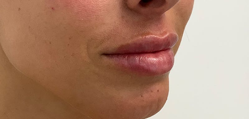 Lip Filler Before & After Gallery - Patient 56158695 - Image 4