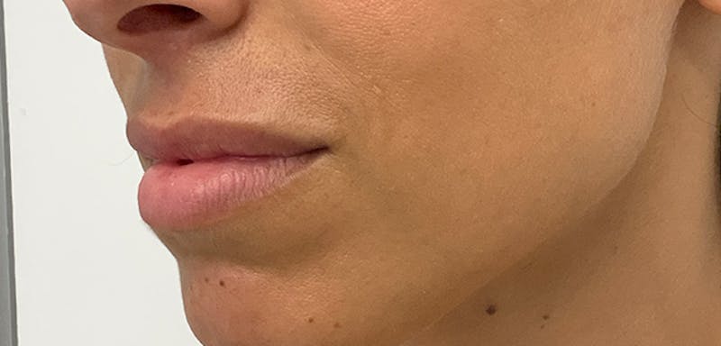 Lip Filler Before & After Gallery - Patient 56158695 - Image 5