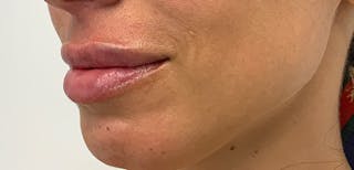 Lip Filler Before & After Gallery - Patient 56158695 - Image 6