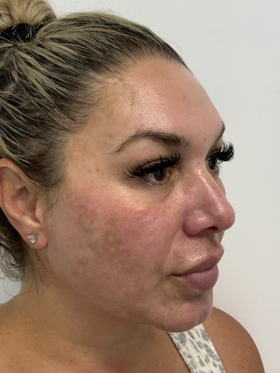 Hydrafacial Before & After Gallery - Patient 56158769 - Image 1