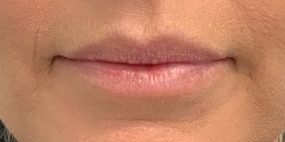 Lip Filler Before & After Gallery - Patient 56158930 - Image 1