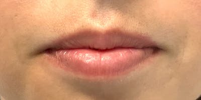Lip Filler Before & After Gallery - Patient 56158931 - Image 1