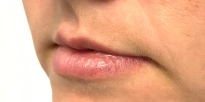 Lip Filler Before & After Gallery - Patient 56158932 - Image 1