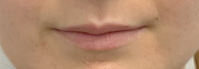 Lip Filler Before & After Gallery - Patient 56161104 - Image 1