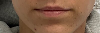 Lip Filler Before & After Gallery - Patient 56161105 - Image 1