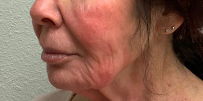 Vivace Microneedling Before & After Gallery - Patient 56161167 - Image 1
