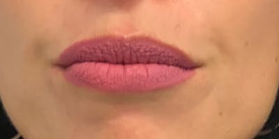 Lip Filler Before & After Gallery - Patient 56161213 - Image 1
