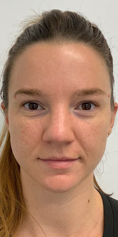 Dermal Fillers Before & After Gallery - Patient 56161281 - Image 1