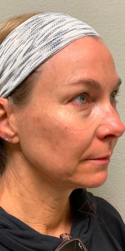 Vivace Microneedling Before & After Gallery - Patient 56162649 - Image 1