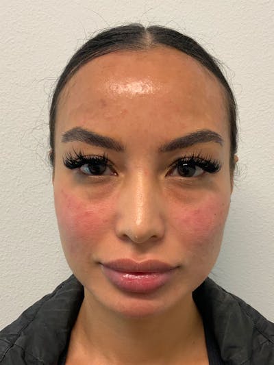 Botox Before & After Gallery - Patient 85222827 - Image 2