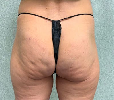 Liquid Butt Lift  Before & After Gallery - Patient 85223048 - Image 1