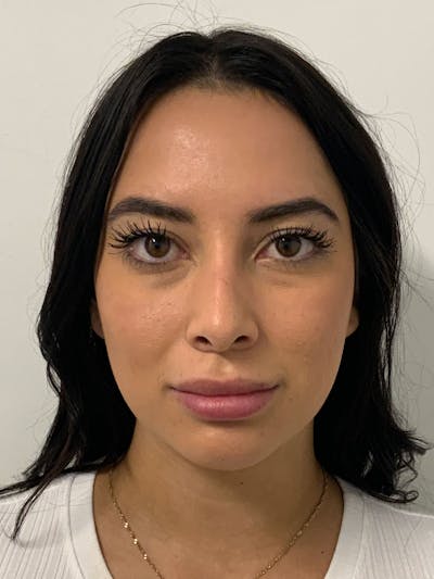 Botox Before & After Gallery - Patient 85223258 - Image 1