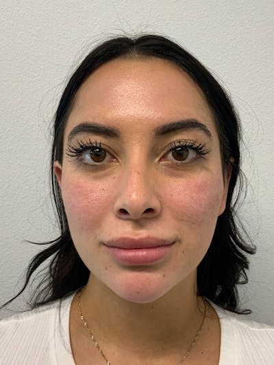 Botox Before & After Gallery - Patient 85223258 - Image 2