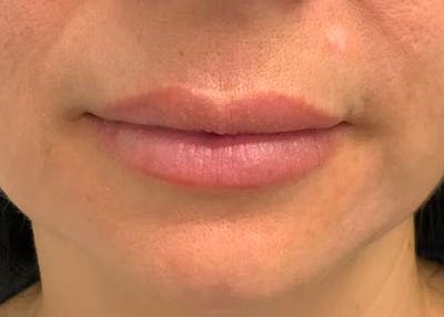 Restylane Before & After Gallery - Patient 85222815 - Image 1