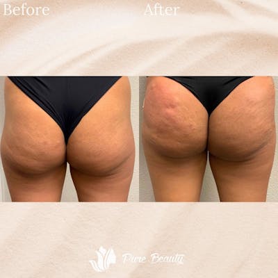 Liquid Butt Lift  Before & After Gallery - Patient 122271638 - Image 1