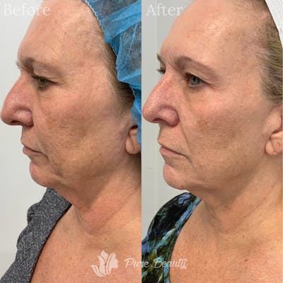 Vivace Microneedling Before & After Gallery - Patient 122290111 - Image 1