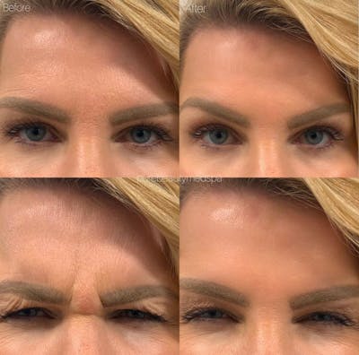 Botox Before & After Gallery - Patient 122290121 - Image 1