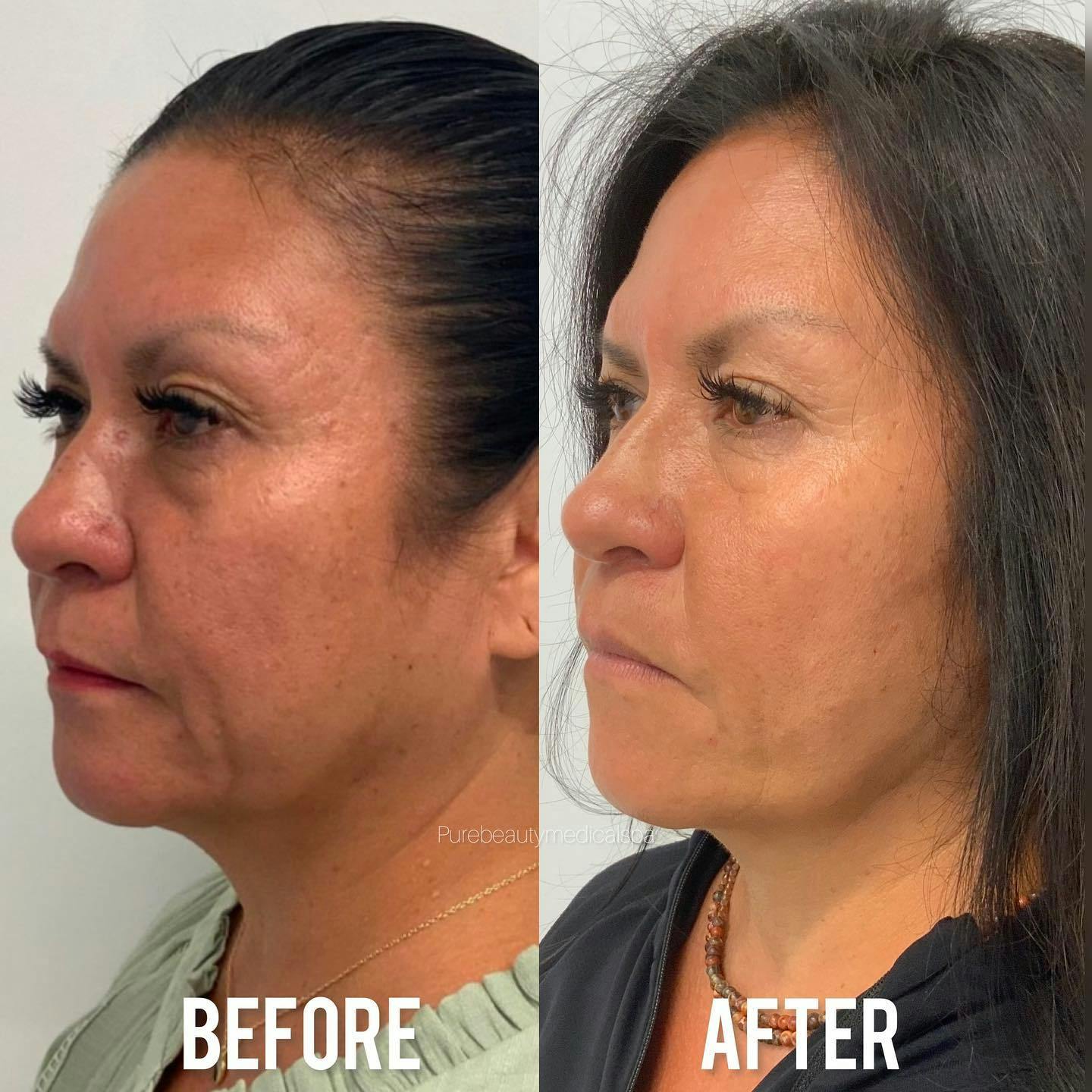 Vivace Microneedling Before & After Gallery - Patient 122290126 - Image 2
