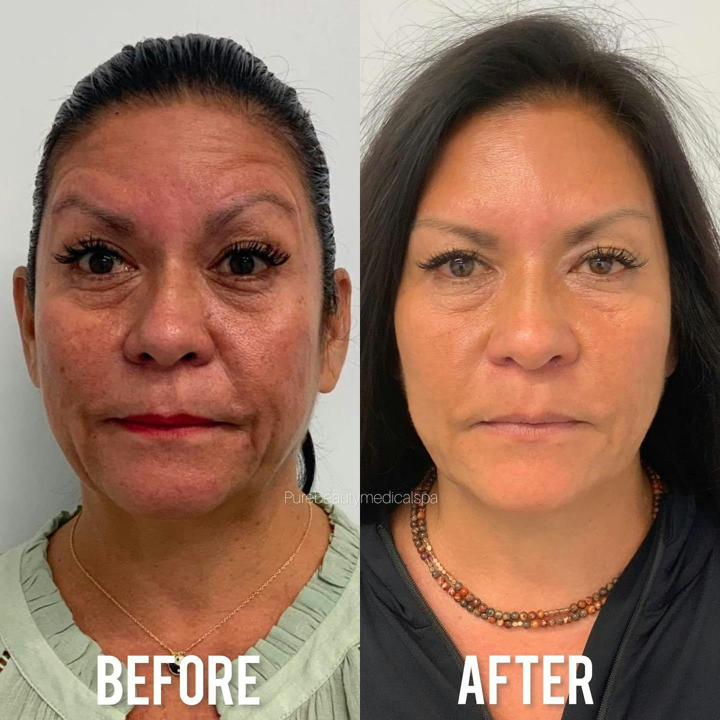 Vivace Microneedling Before & After Gallery - Patient 122290126 - Image 1