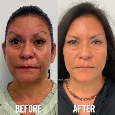 Vivace Microneedling Before & After Gallery - Patient 122290126 - Image 1