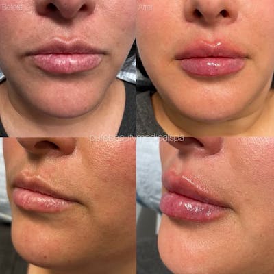 Lip Filler Before & After Gallery - Patient 122290131 - Image 1