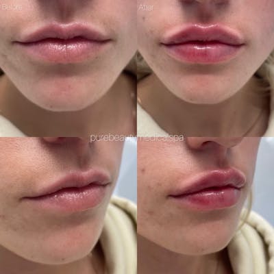 Lip Filler Before & After Gallery - Patient 122290169 - Image 1