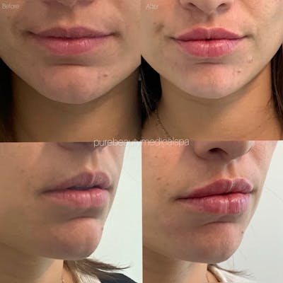 Lip Filler Before & After Gallery - Patient 122290186 - Image 1