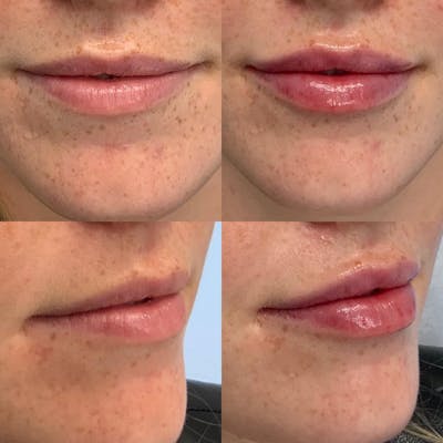 Lip Filler Before & After Gallery - Patient 122290197 - Image 1