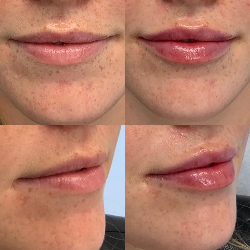 Lip Filler Before & After Gallery - Patient 122290197 - Image 1