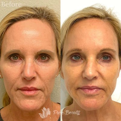 Vivace Microneedling Before & After Gallery - Patient 122290217 - Image 1