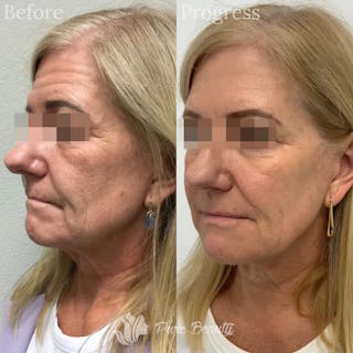Vivace Microneedling Before & After Gallery - Patient 122290248 - Image 2
