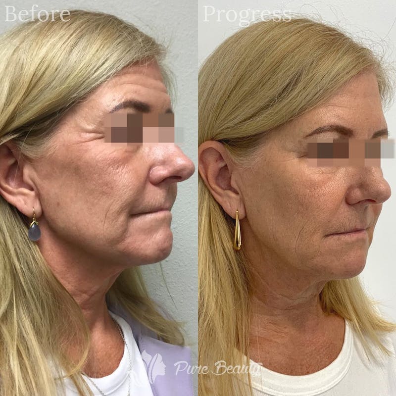 Vivace Microneedling Before & After Gallery - Patient 122290248 - Image 3