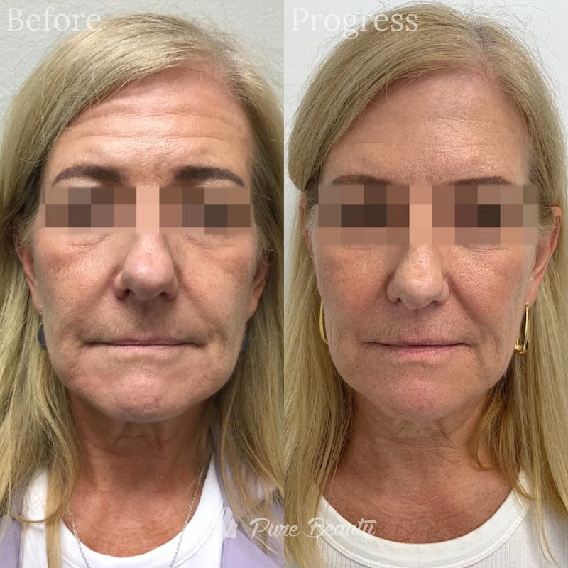 Vivace Microneedling Before & After Gallery - Patient 122290248 - Image 1