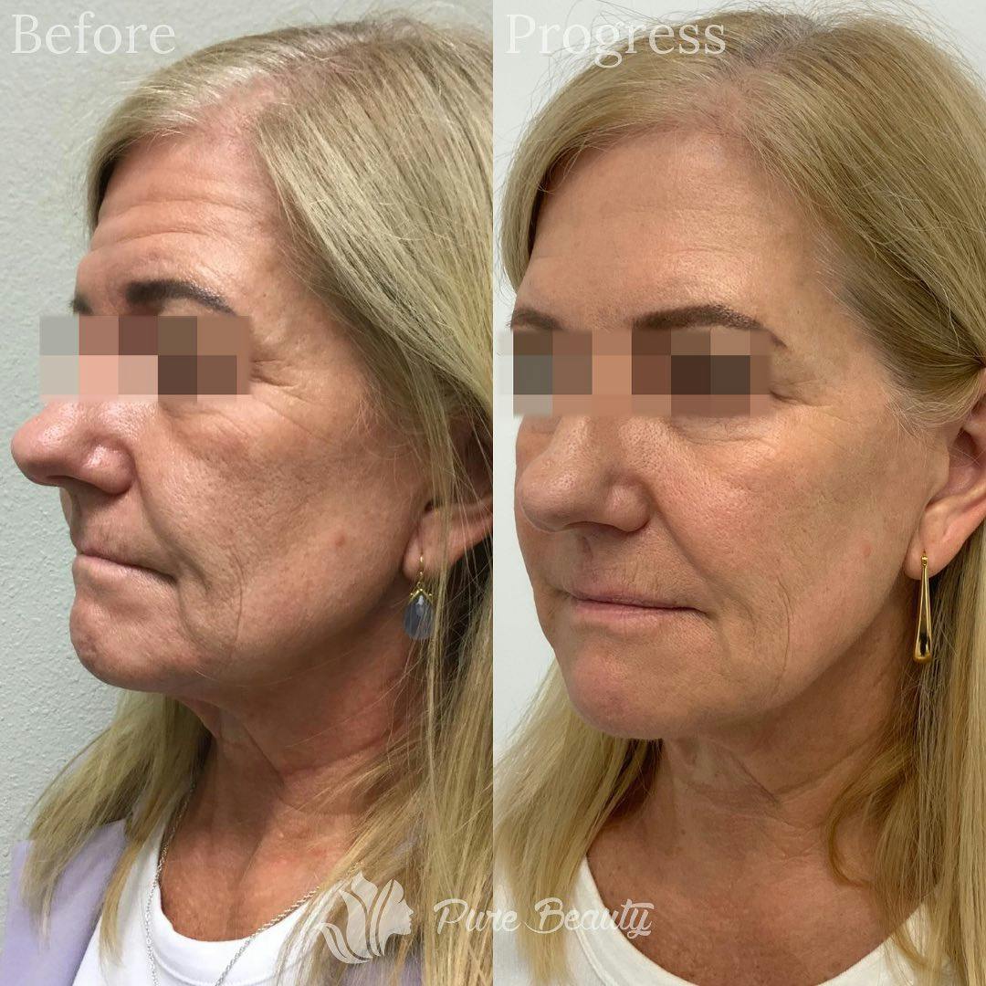 Botox Before & After Gallery - Patient 122290252 - Image 2
