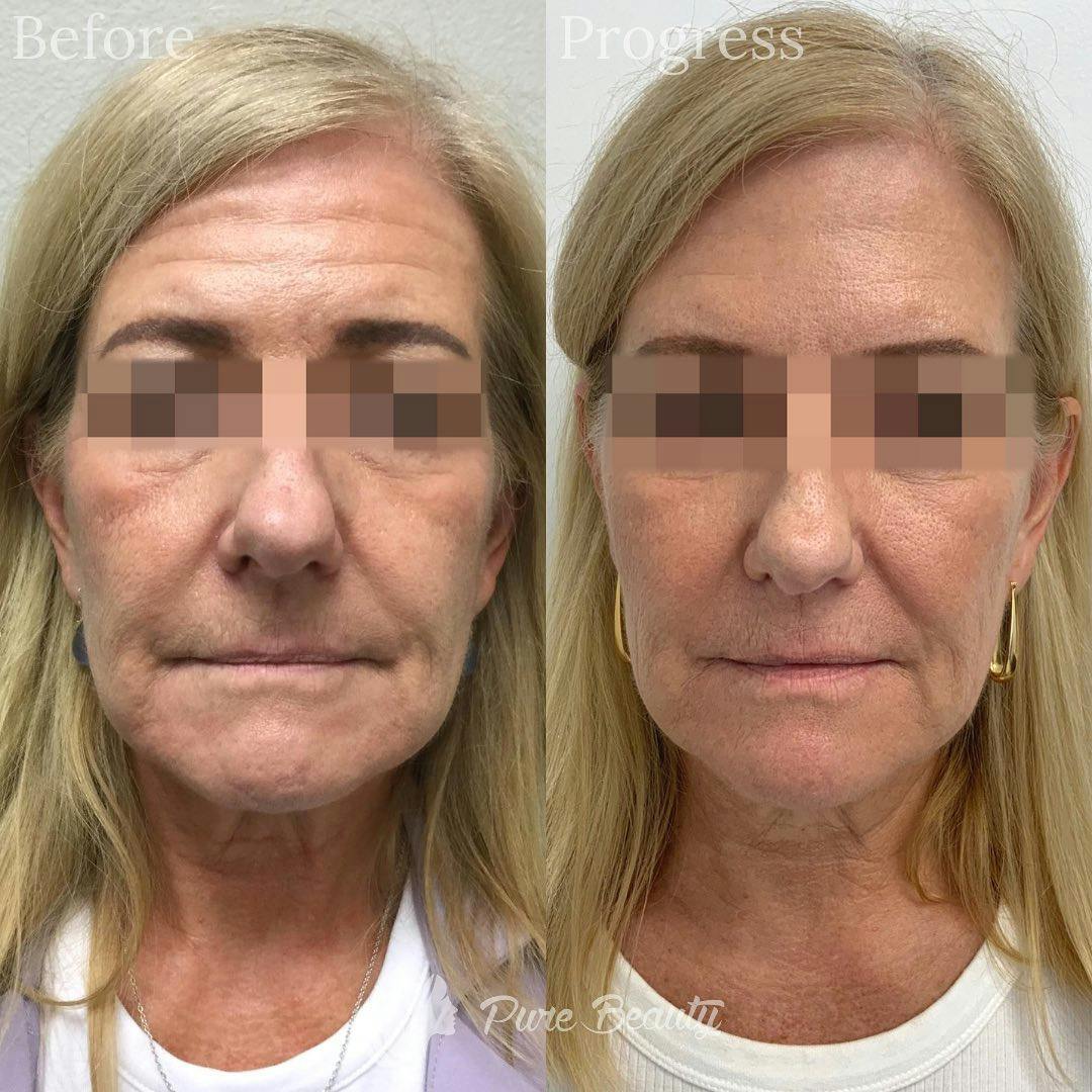 Botox Before & After Gallery - Patient 122290252 - Image 1