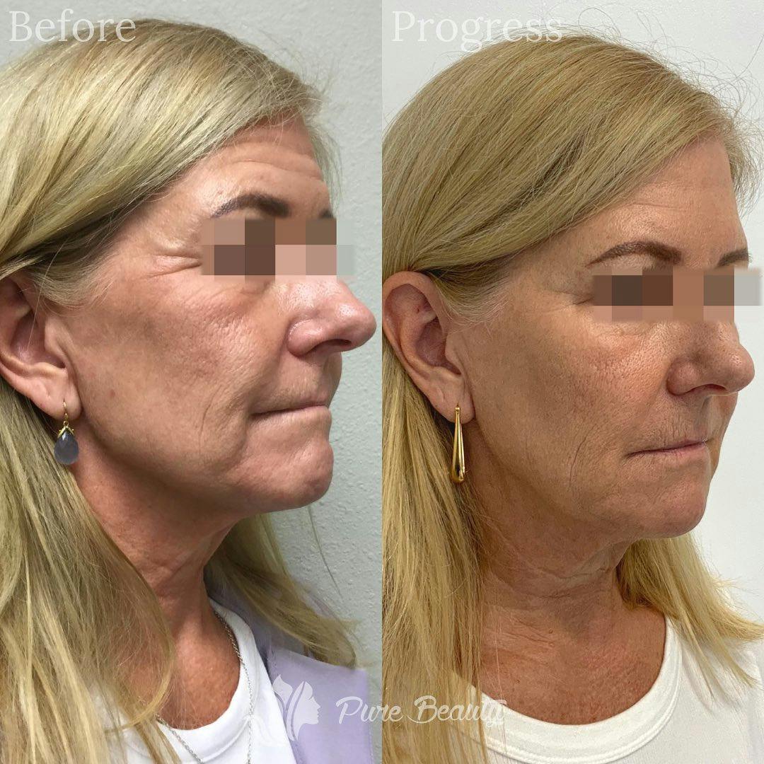Restylane Before & After Gallery - Patient 122290256 - Image 3
