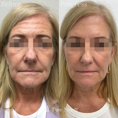 Restylane Before & After Gallery - Patient 122290256 - Image 1
