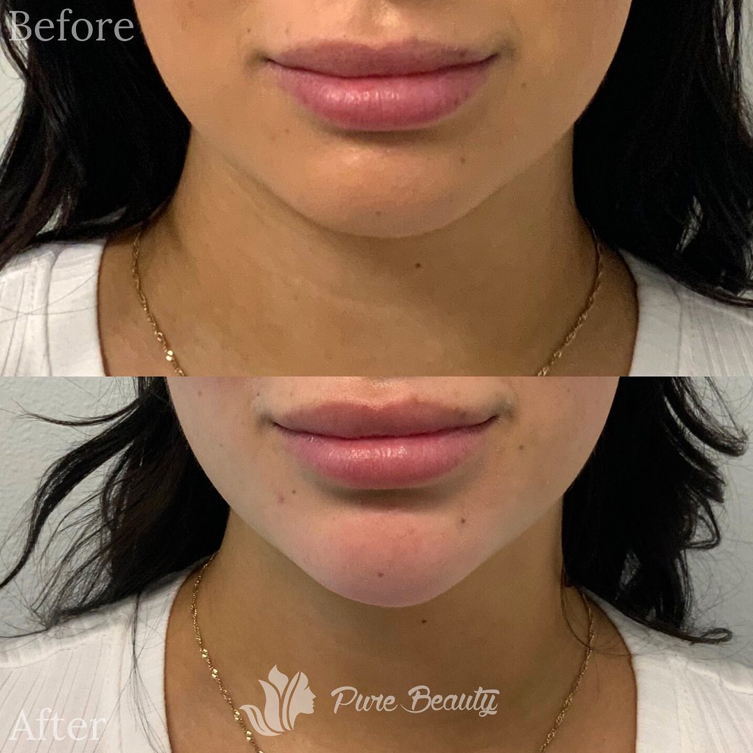 Dermal Fillers Before & After Photos Pure Beauty Medical Spa