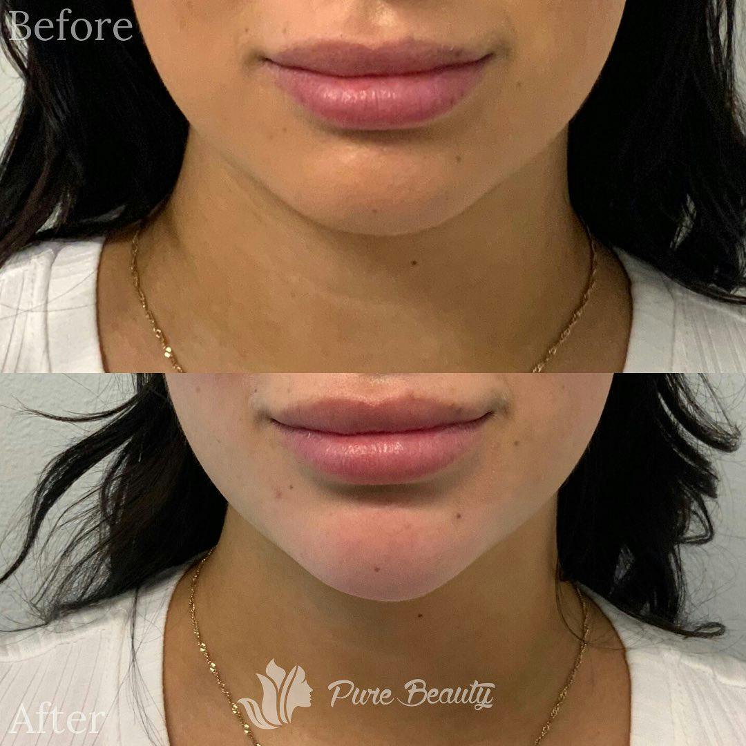 Dermal Fillers Before & After Gallery - Patient 122290265 - Image 1