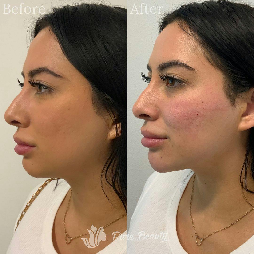 Dermal Fillers Before & After Gallery - Patient 122290265 - Image 2