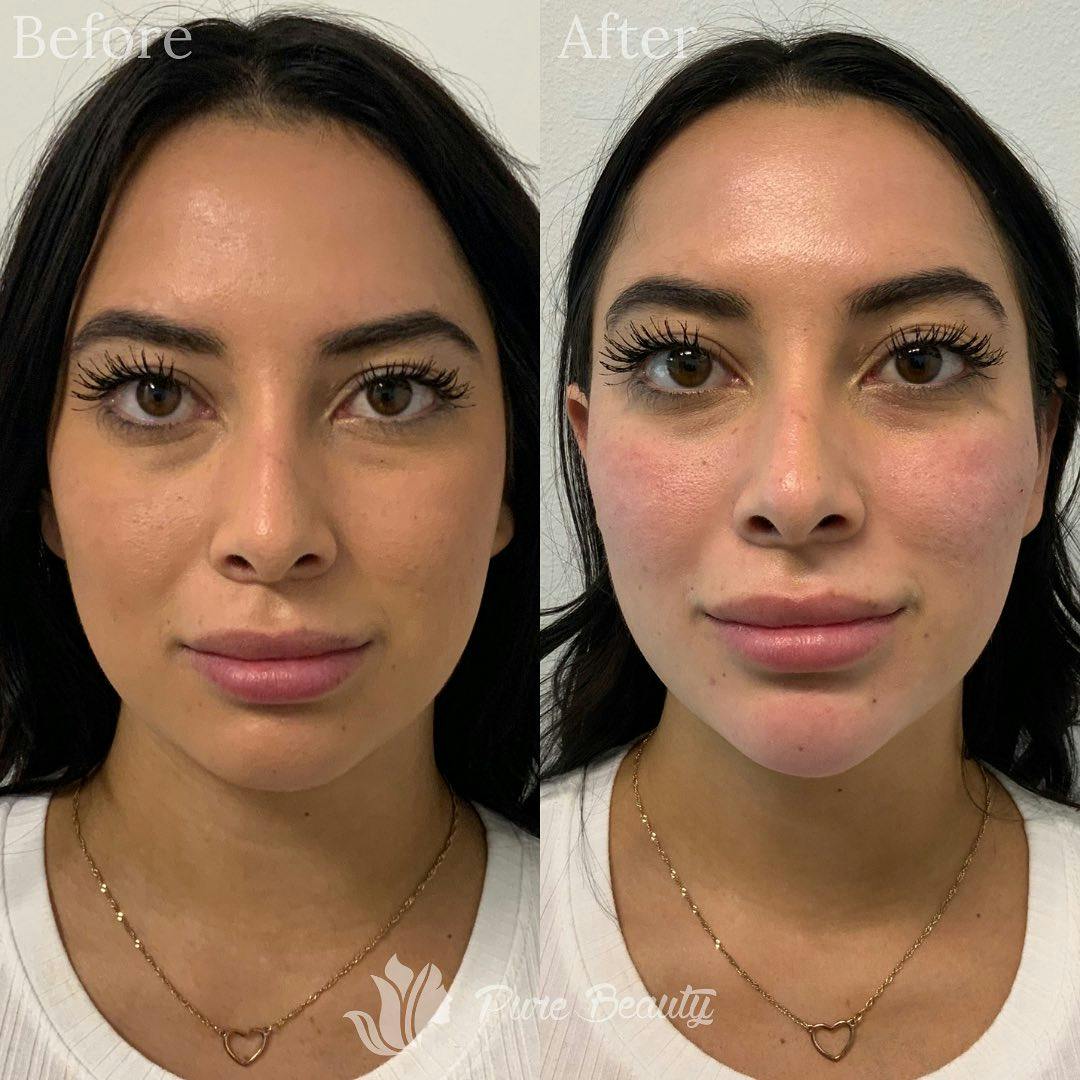 Dermal Fillers Before & After Gallery - Patient 122290265 - Image 3