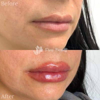 Restylane Before & After Gallery - Patient 122290267 - Image 1