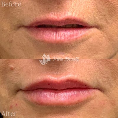 Restylane Before & After Gallery - Patient 122290268 - Image 1