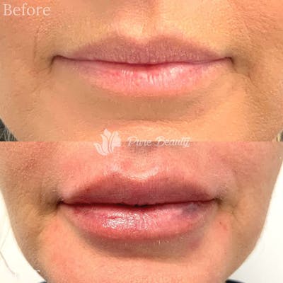 Restylane Before & After Gallery - Patient 122290314 - Image 1