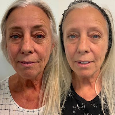Vivace Microneedling Before & After Gallery - Patient 142705649 - Image 1